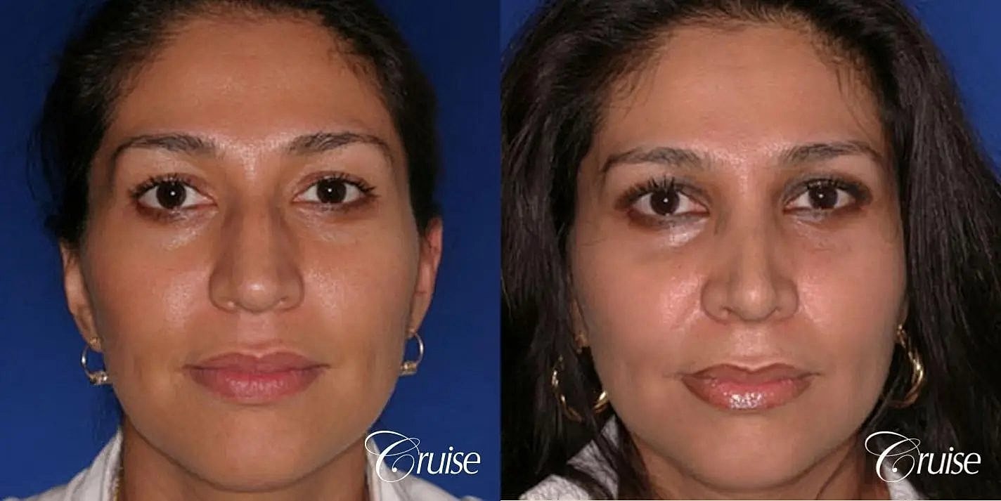Rhinoplasty Before & After