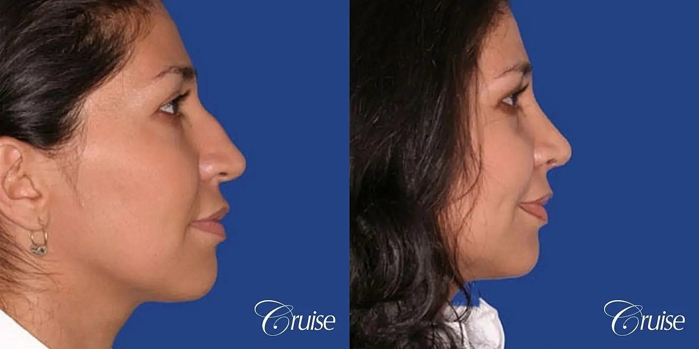 Rhinoplasty Before & After