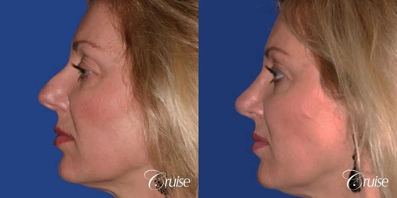 Rhinoplasty Before & After