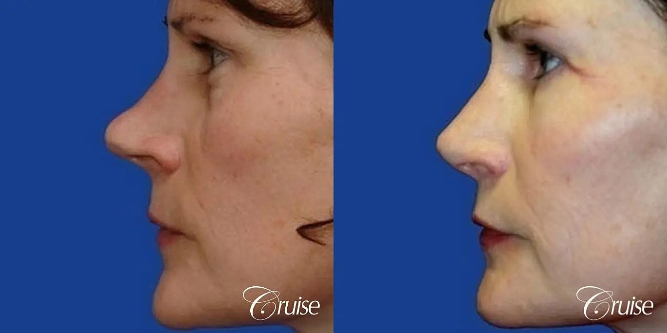 Rhinoplasty Before & After