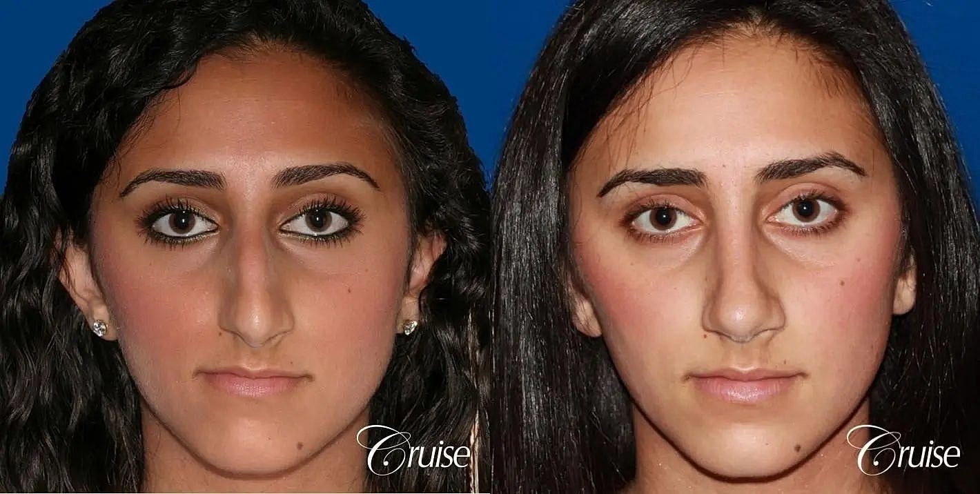 Rhinoplasty Before & After