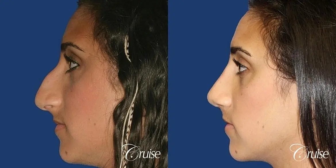 Rhinoplasty Before & After