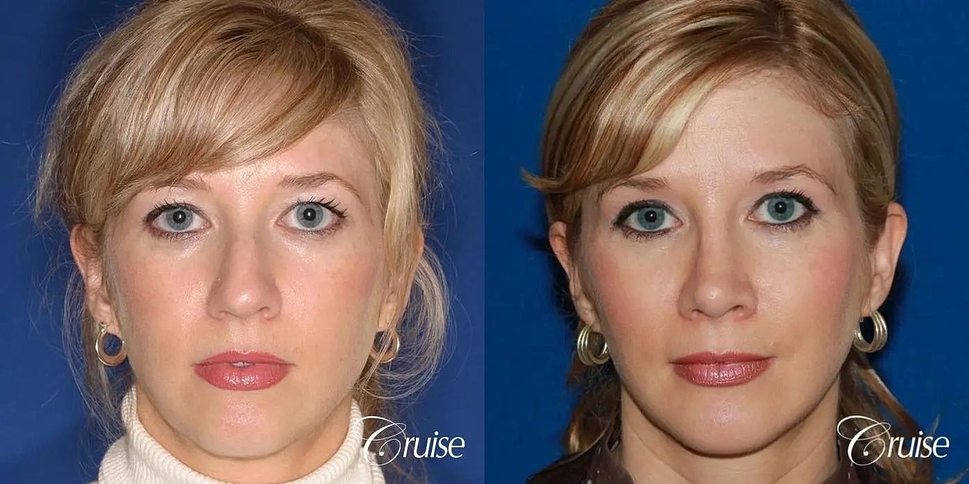 Rhinoplasty Before & After