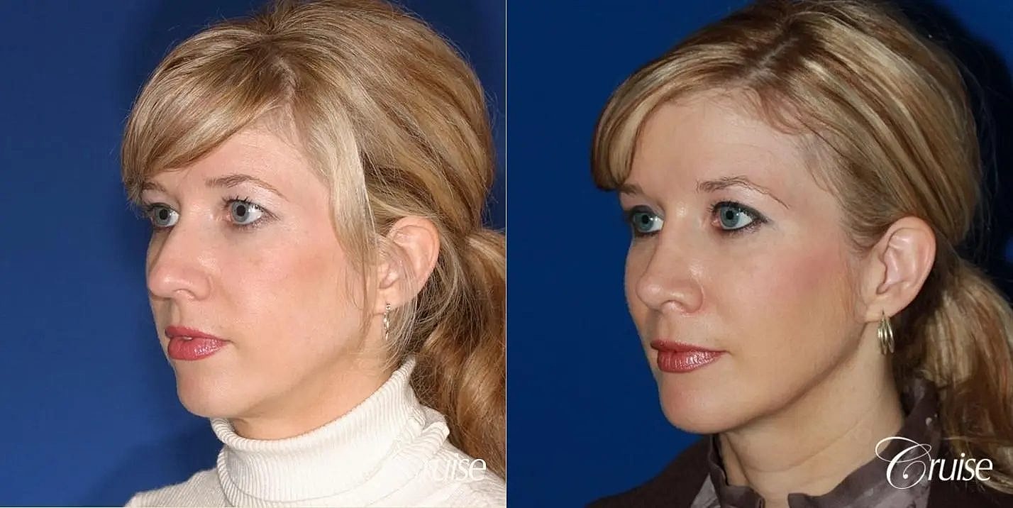 Rhinoplasty Before & After
