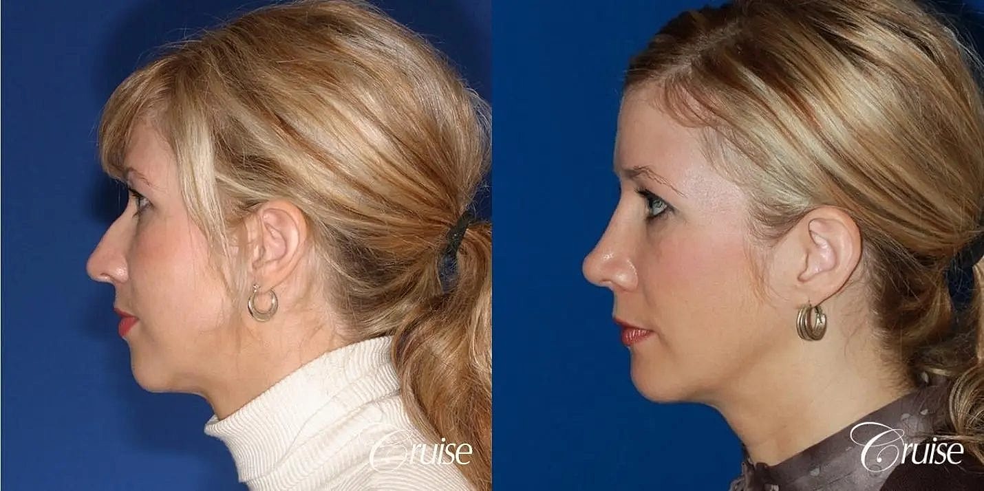 Rhinoplasty Before & After