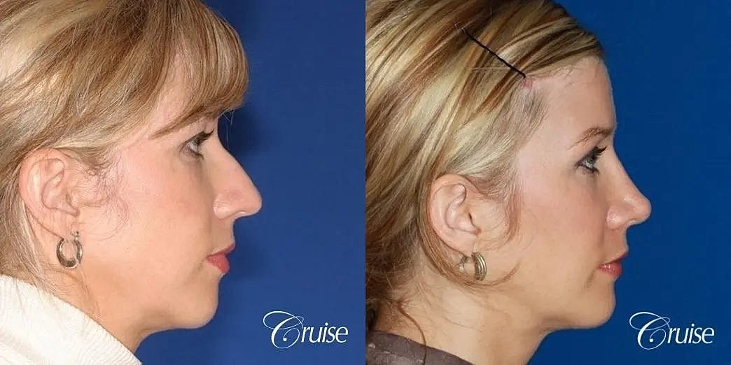 Rhinoplasty Before & After
