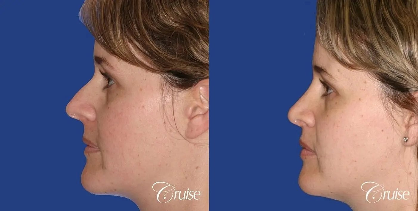 Rhinoplasty Before & After