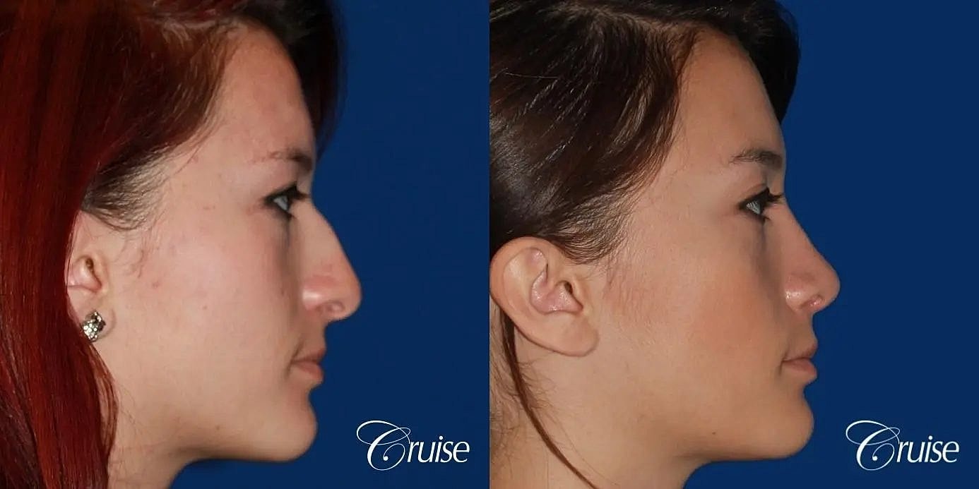 Rhinoplasty Before & After