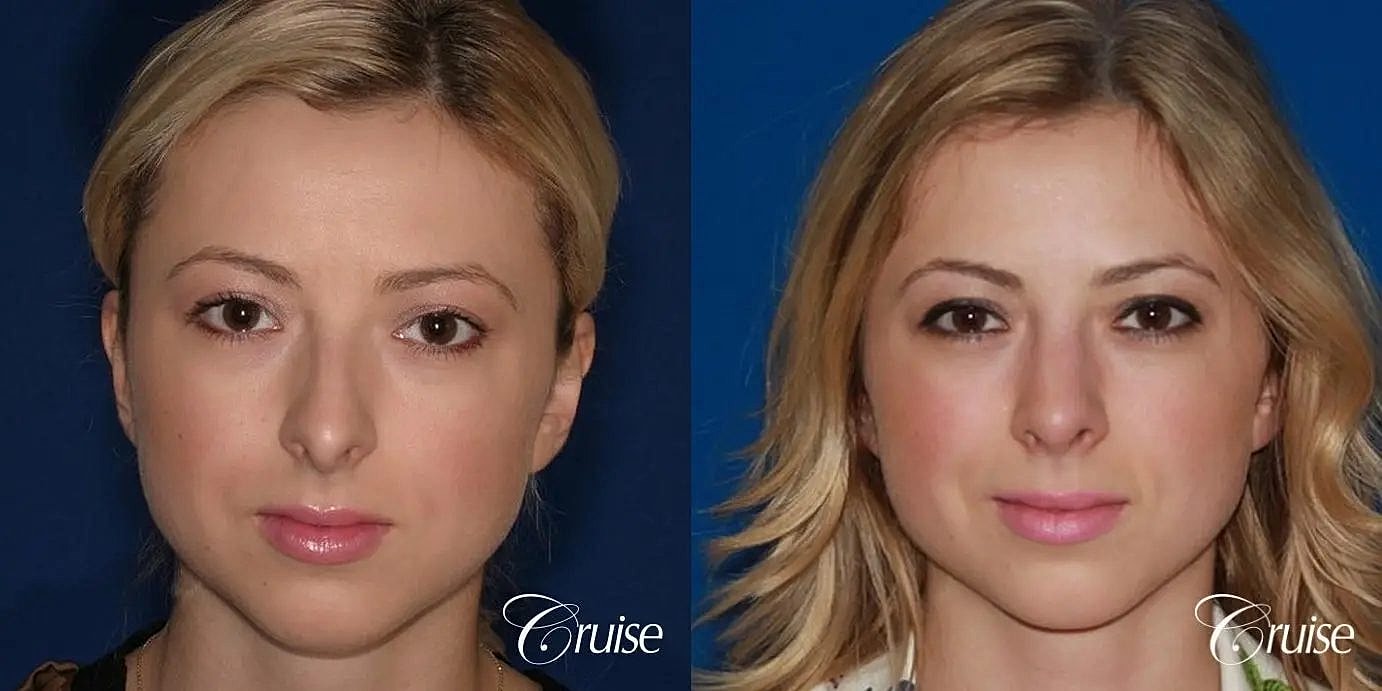 Rhinoplasty Before & After
