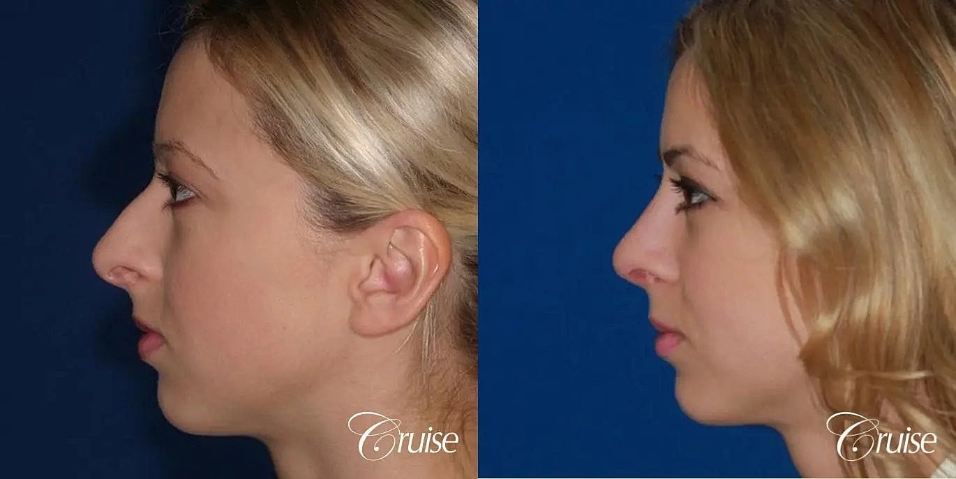 Rhinoplasty Before & After