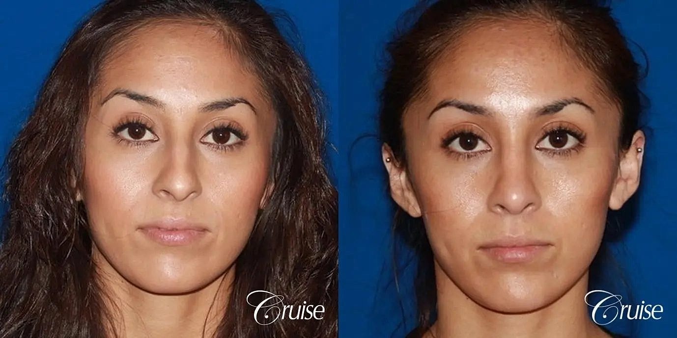 Rhinoplasty Before & After