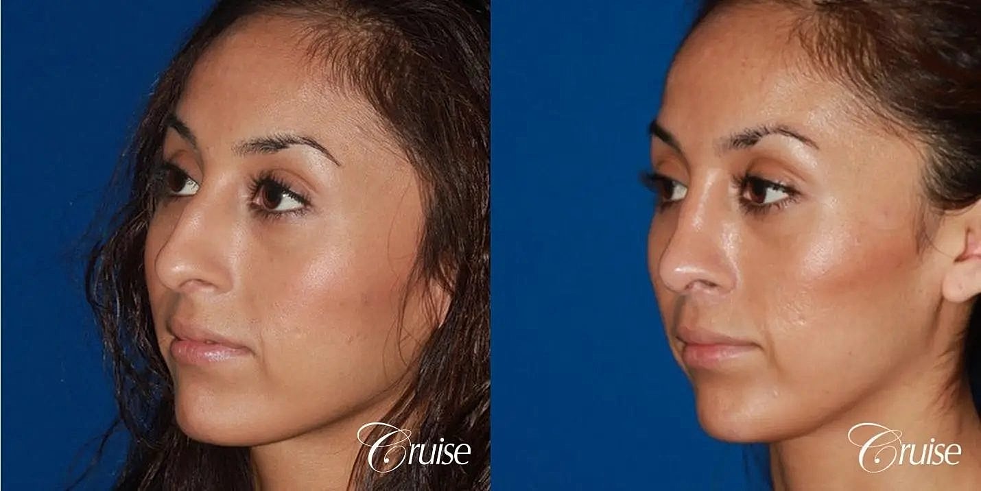 Rhinoplasty Before & After