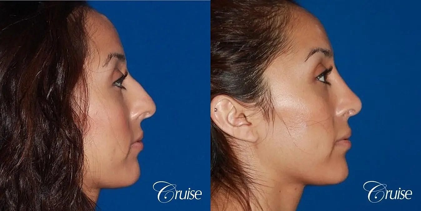Rhinoplasty Before & After