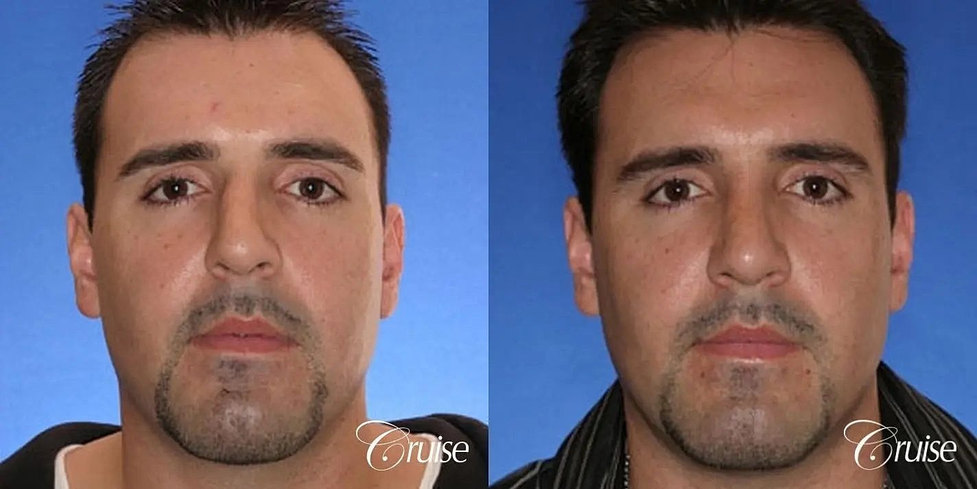 Rhinoplasty Before & After