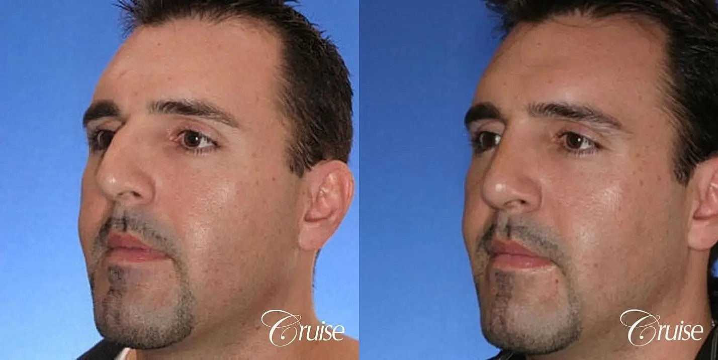 Rhinoplasty Before & After