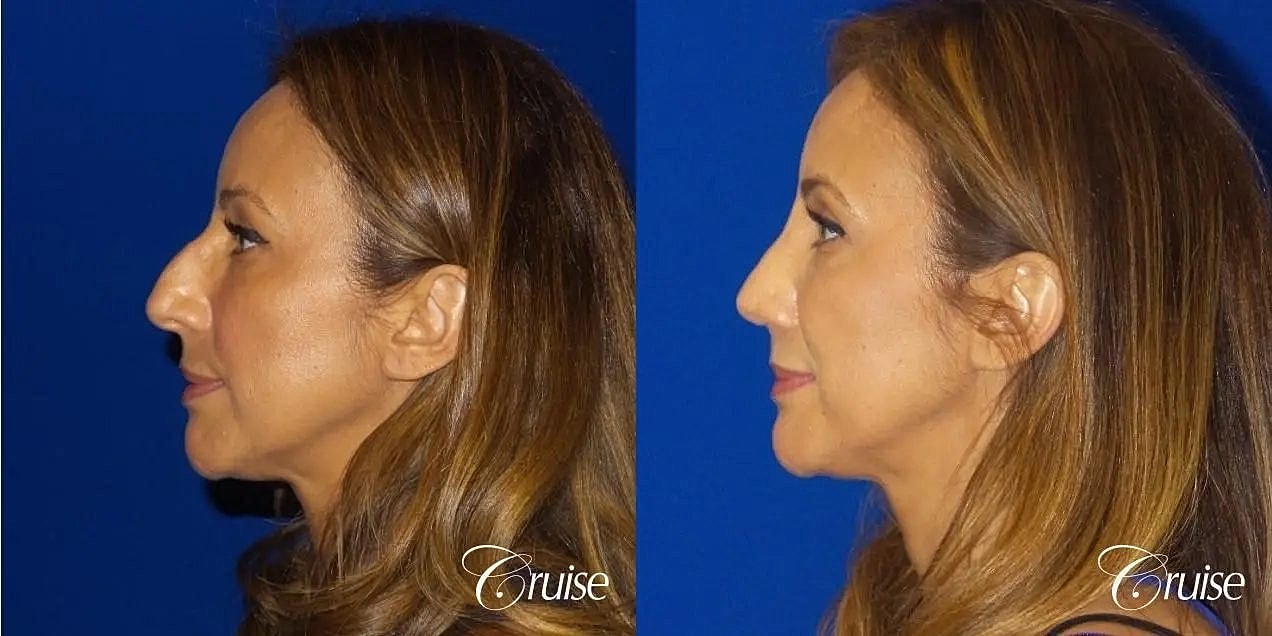 Rhinoplasty Before & After