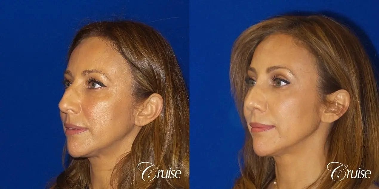 Rhinoplasty Before & After