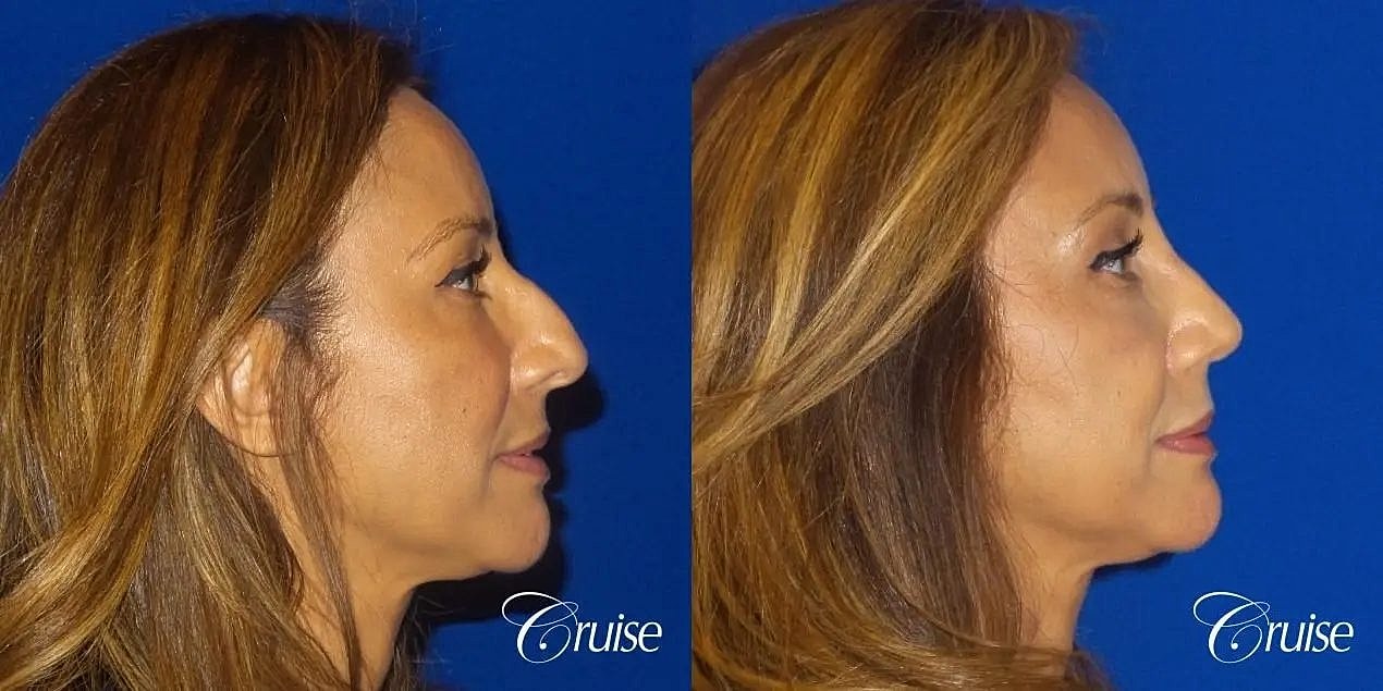 Rhinoplasty Before & After