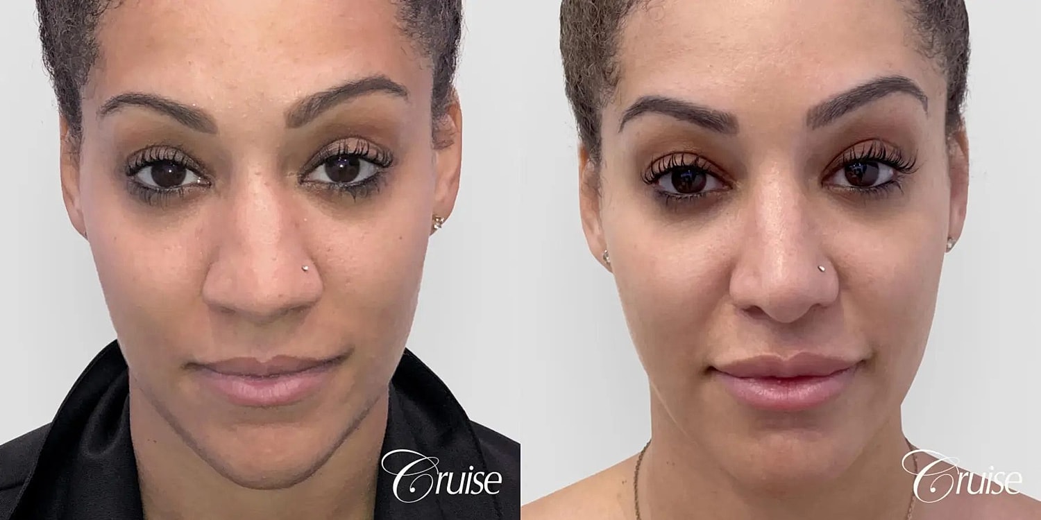 Rhinoplasty Before & After