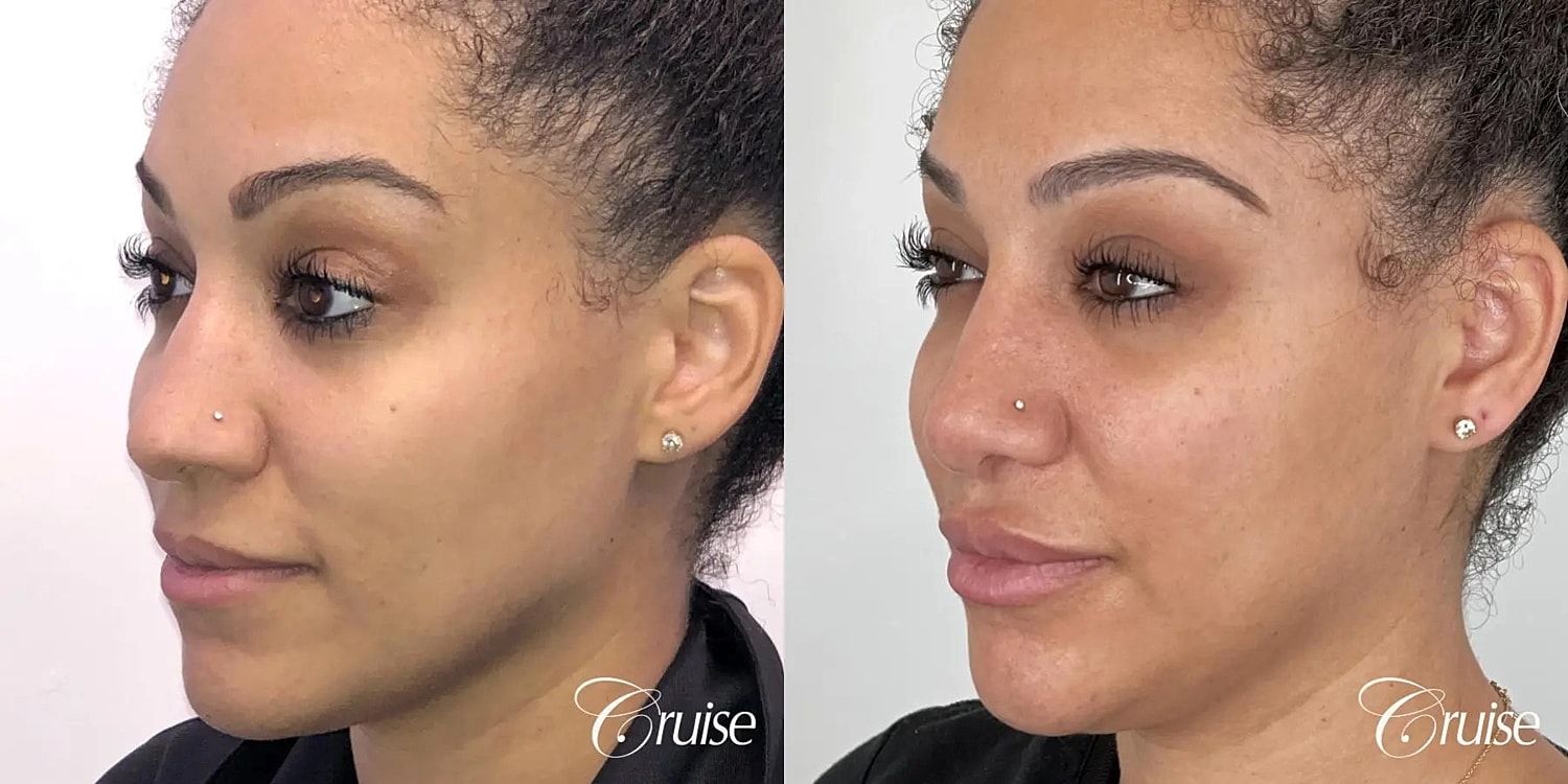 Rhinoplasty Before & After