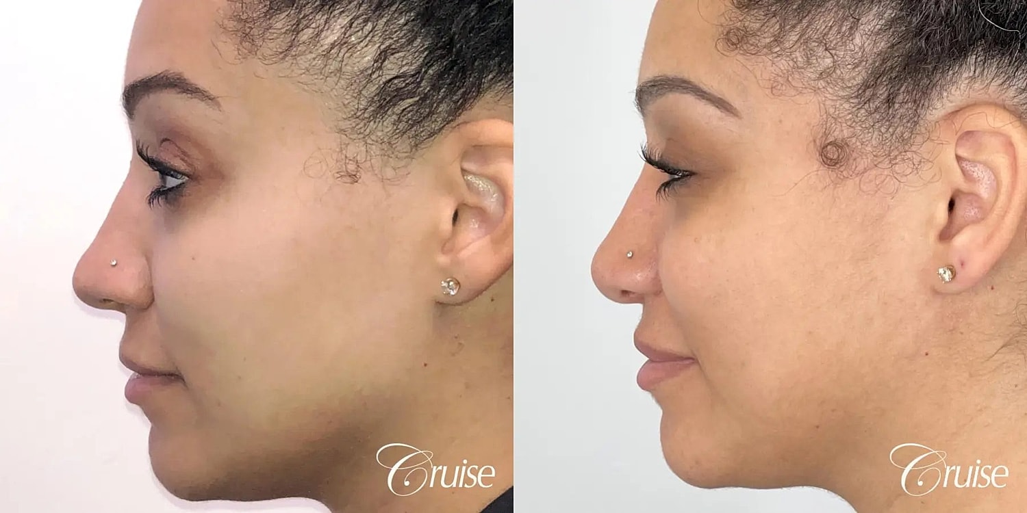 Rhinoplasty Before & After