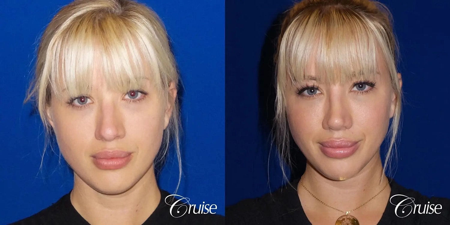 Rhinoplasty Before & After