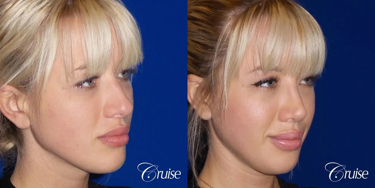 Rhinoplasty Before & After