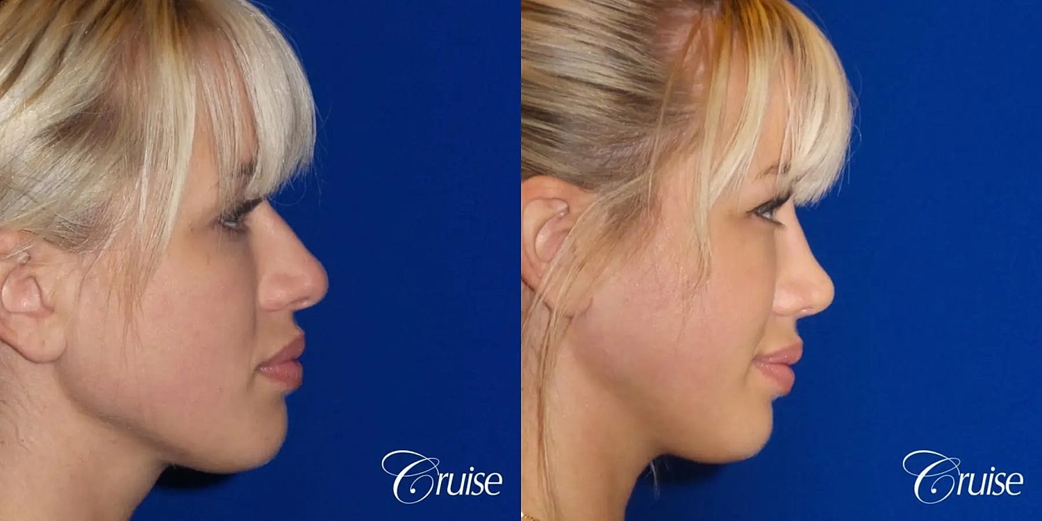 Rhinoplasty Before & After