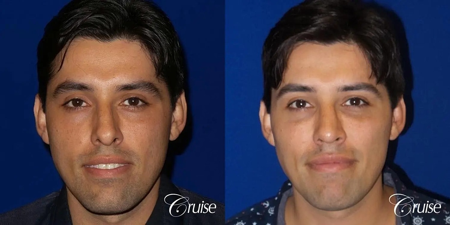 Rhinoplasty Before & After