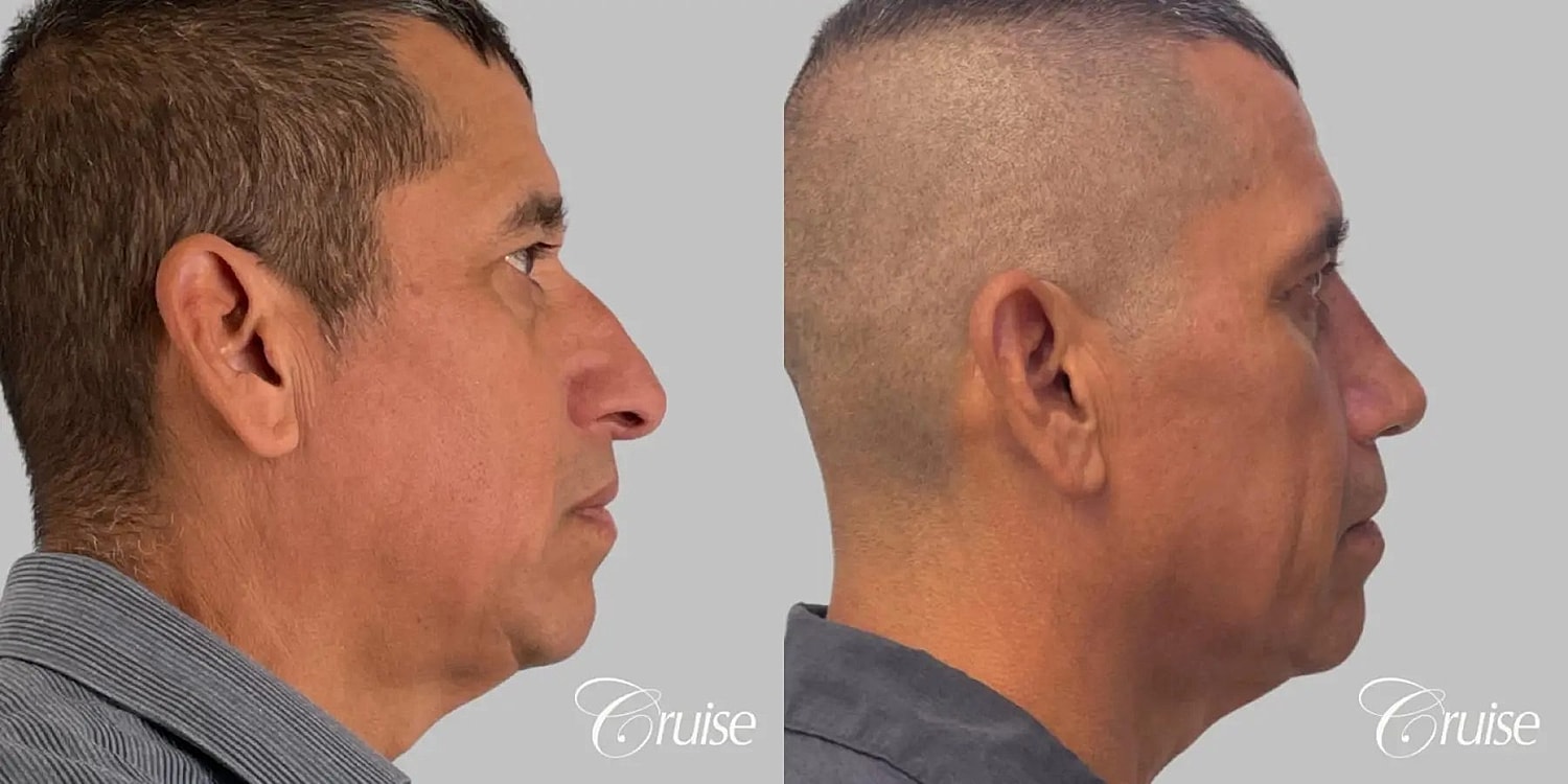 Rhinoplasty Before & After