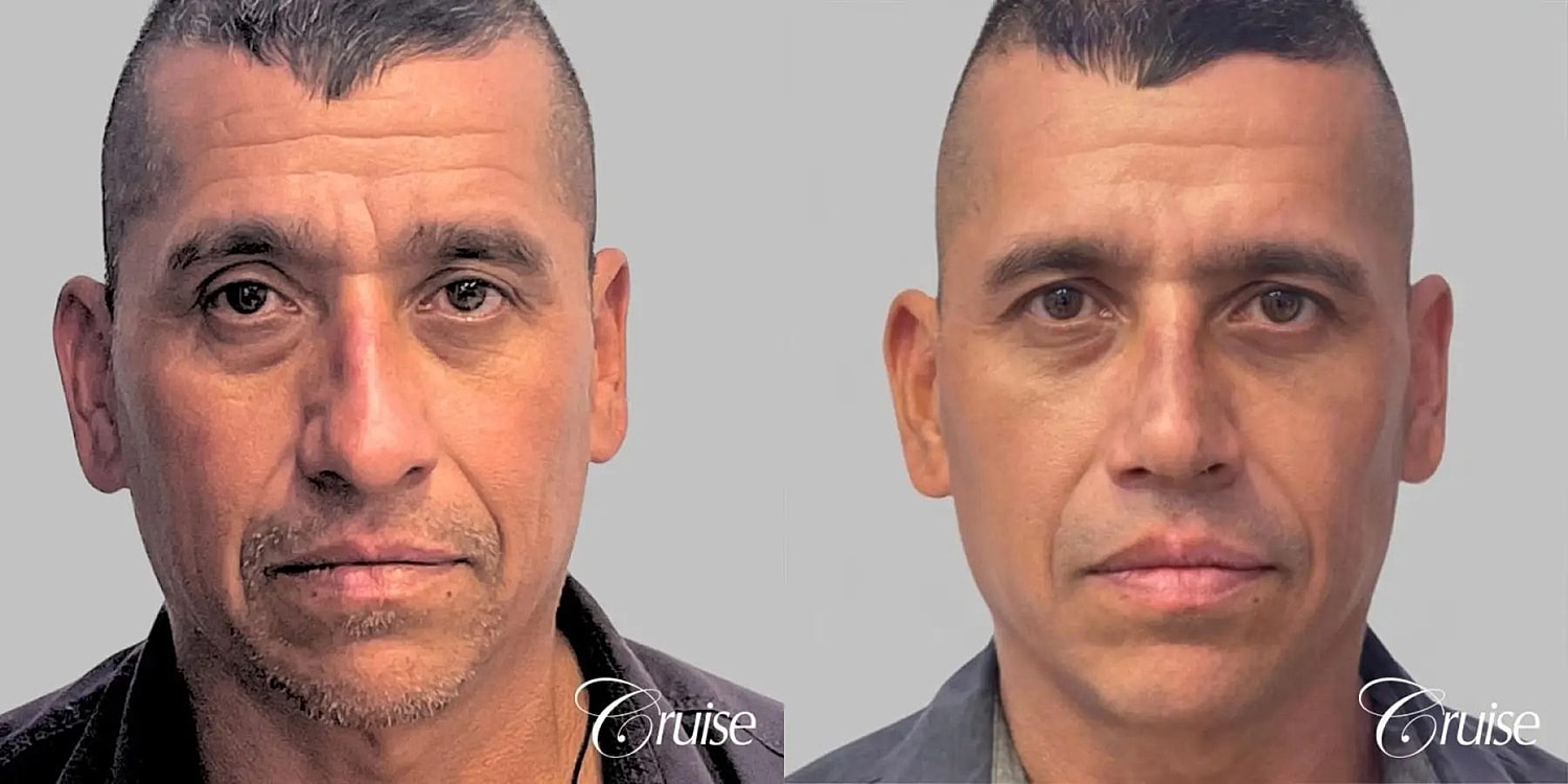 Rhinoplasty Before & After