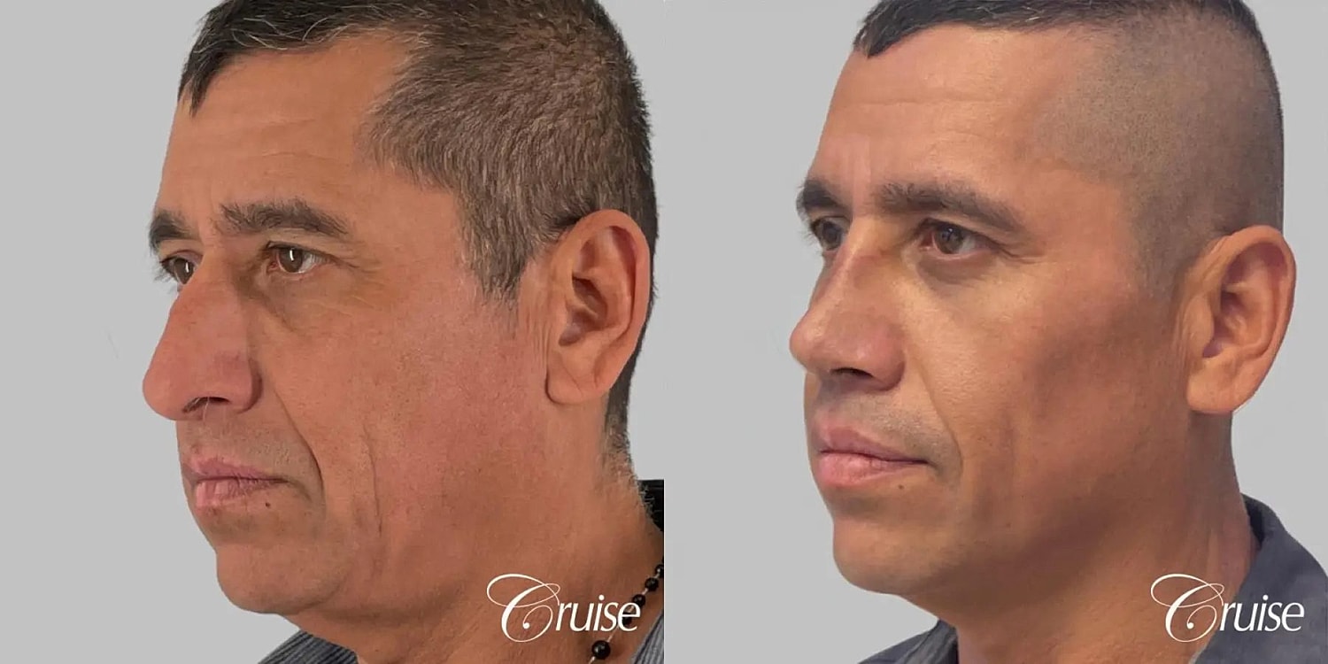 Rhinoplasty Before & After