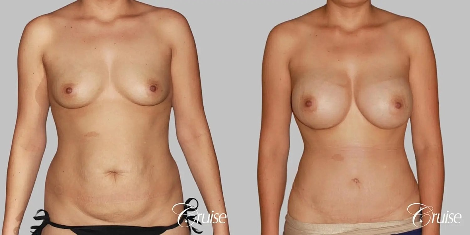 Mommy Makeover Before & After