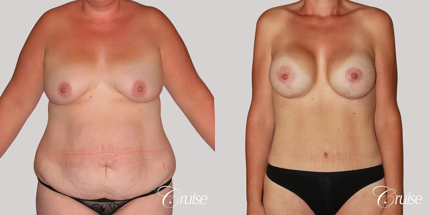 Mommy Makeover Before & After