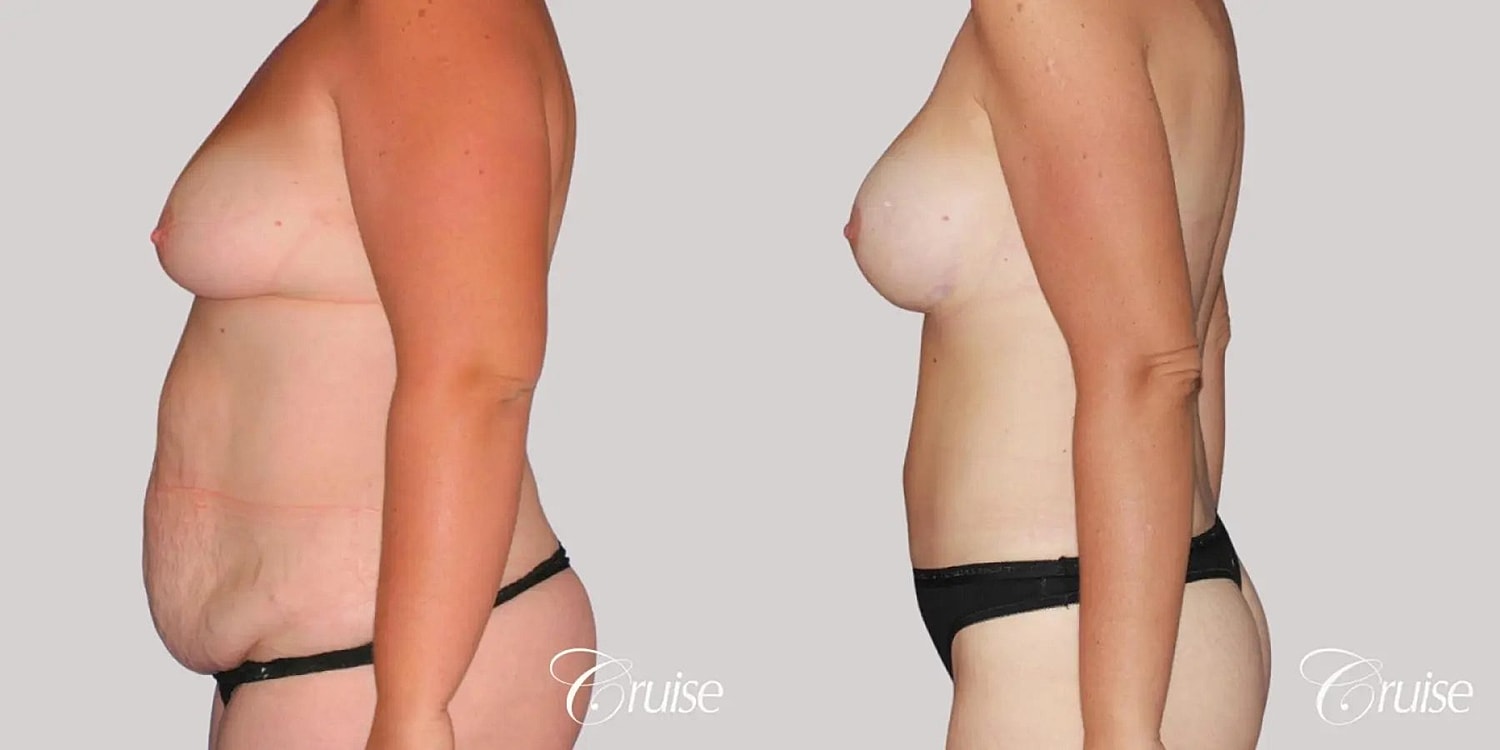 Mommy Makeover Before & After