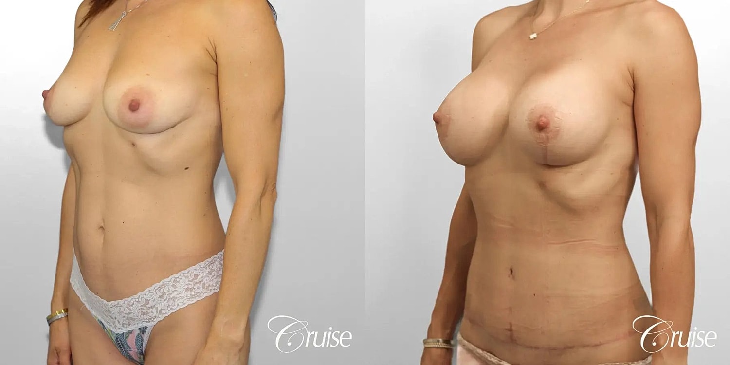 Mommy Makeover Before & After