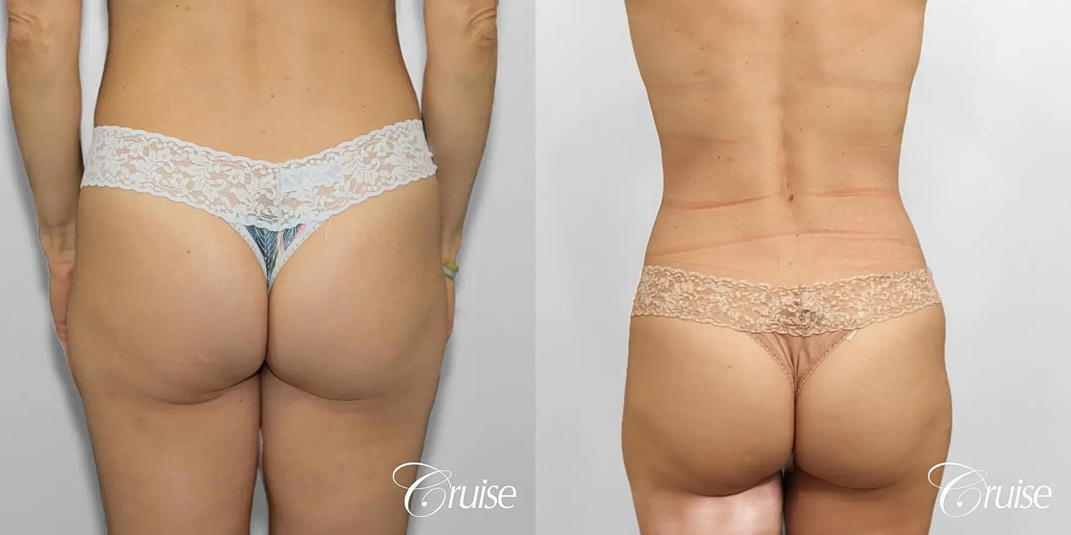 Mommy Makeover Before & After