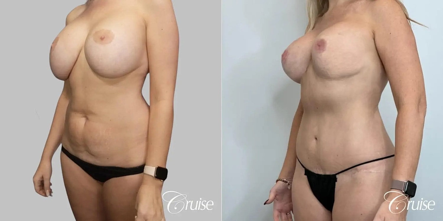 Mommy Makeover Before & After