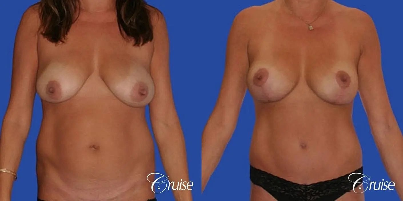 Mommy Makeover Before & After