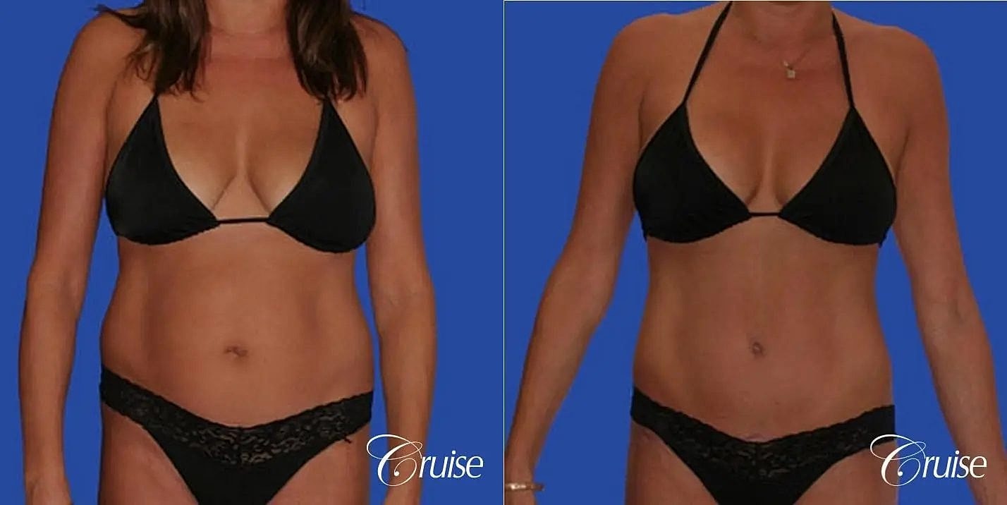 Mommy Makeover Before & After