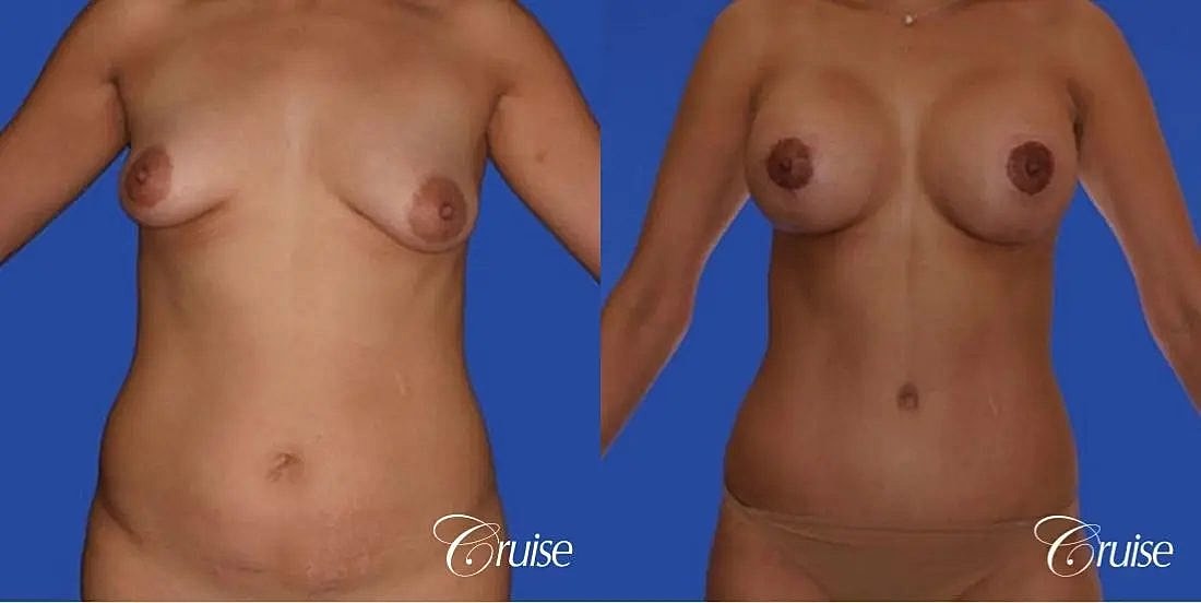 Mommy Makeover Before & After