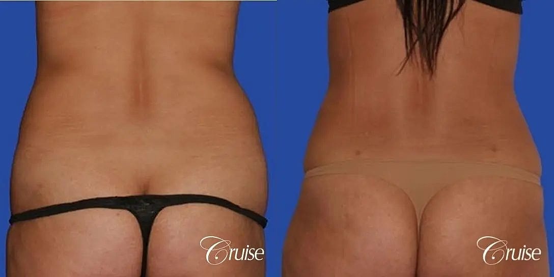 Mommy Makeover Before & After