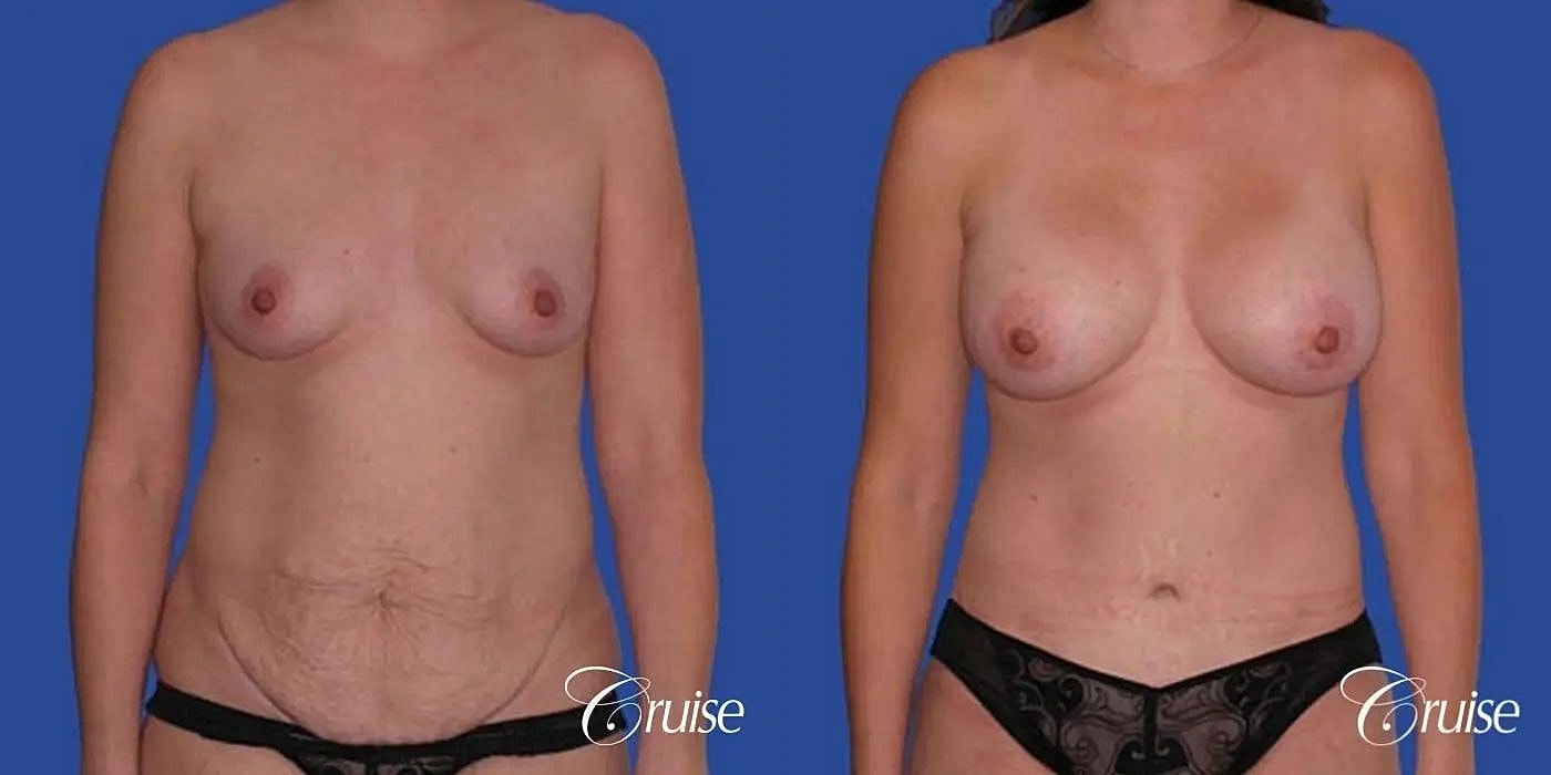 Mommy Makeover Before & After