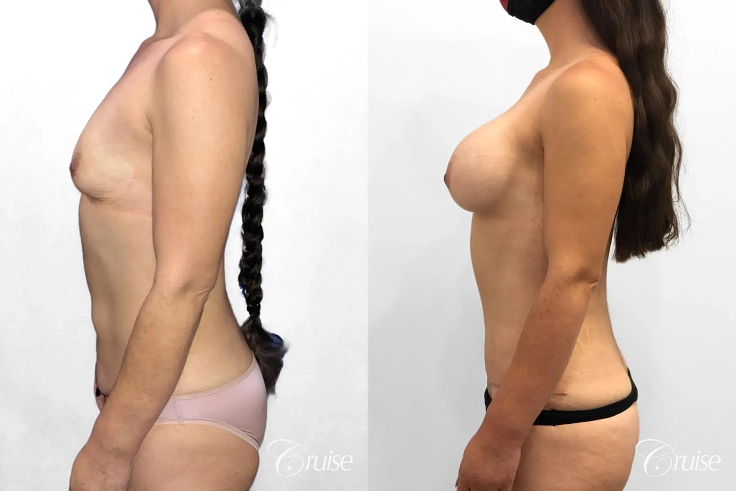 Mommy Makeover Before & After