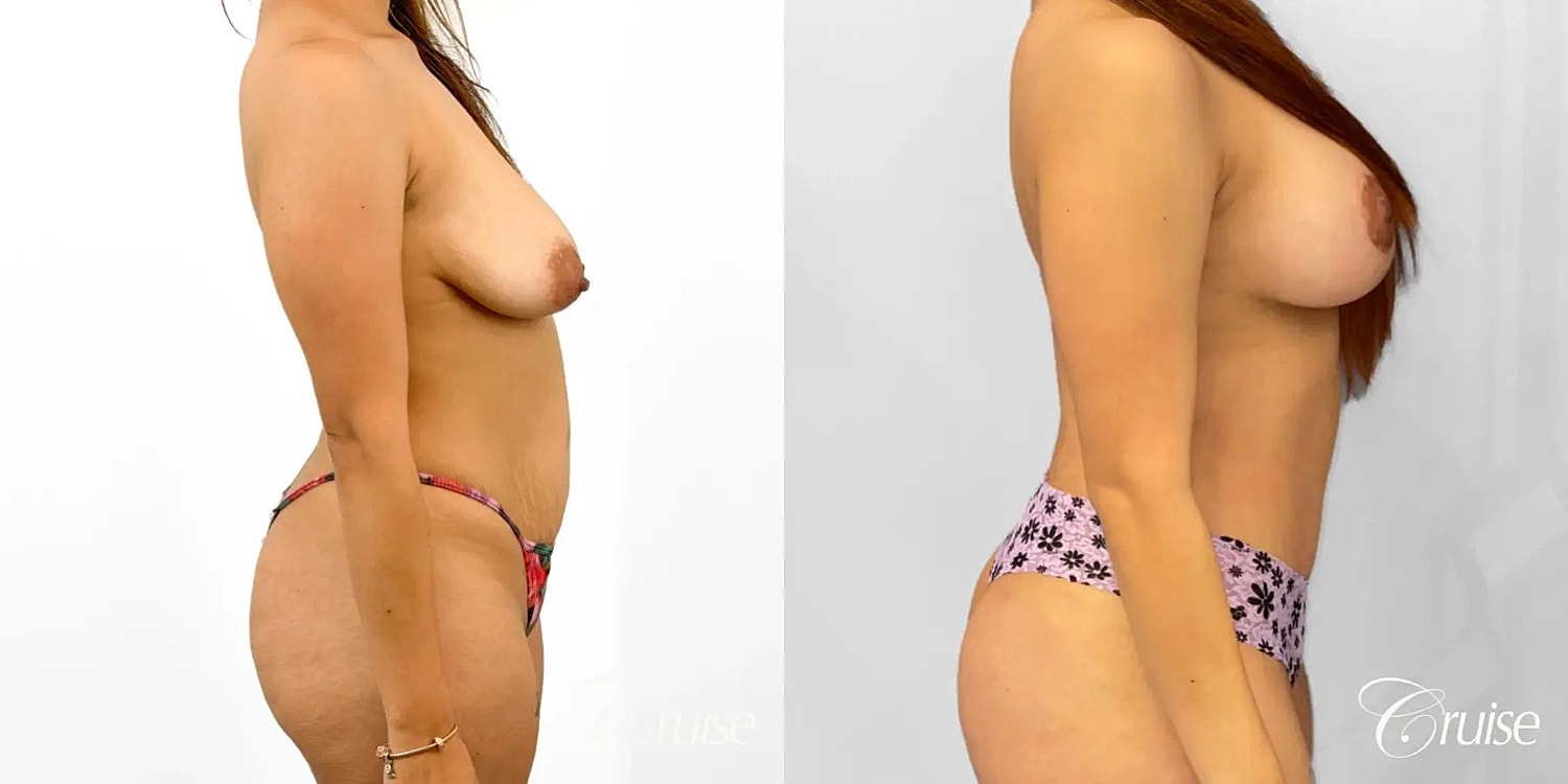 Mommy Makeover Before & After