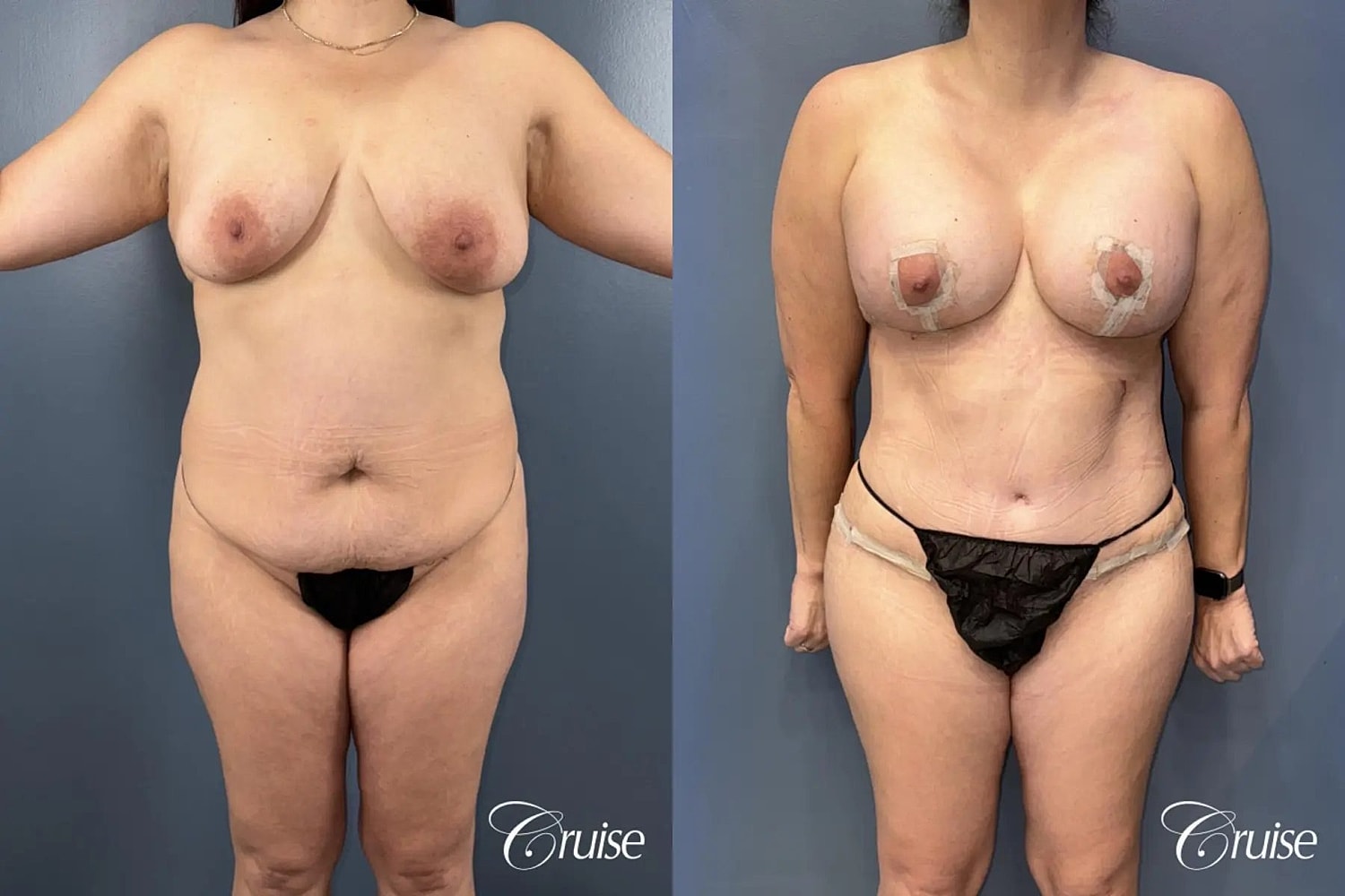 Mommy Makeover Before & After