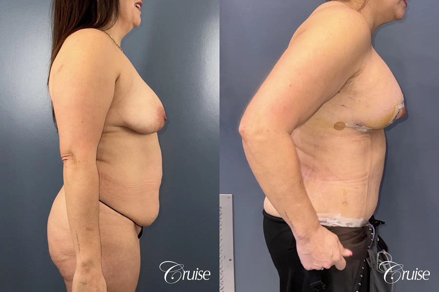 Mommy Makeover Before & After