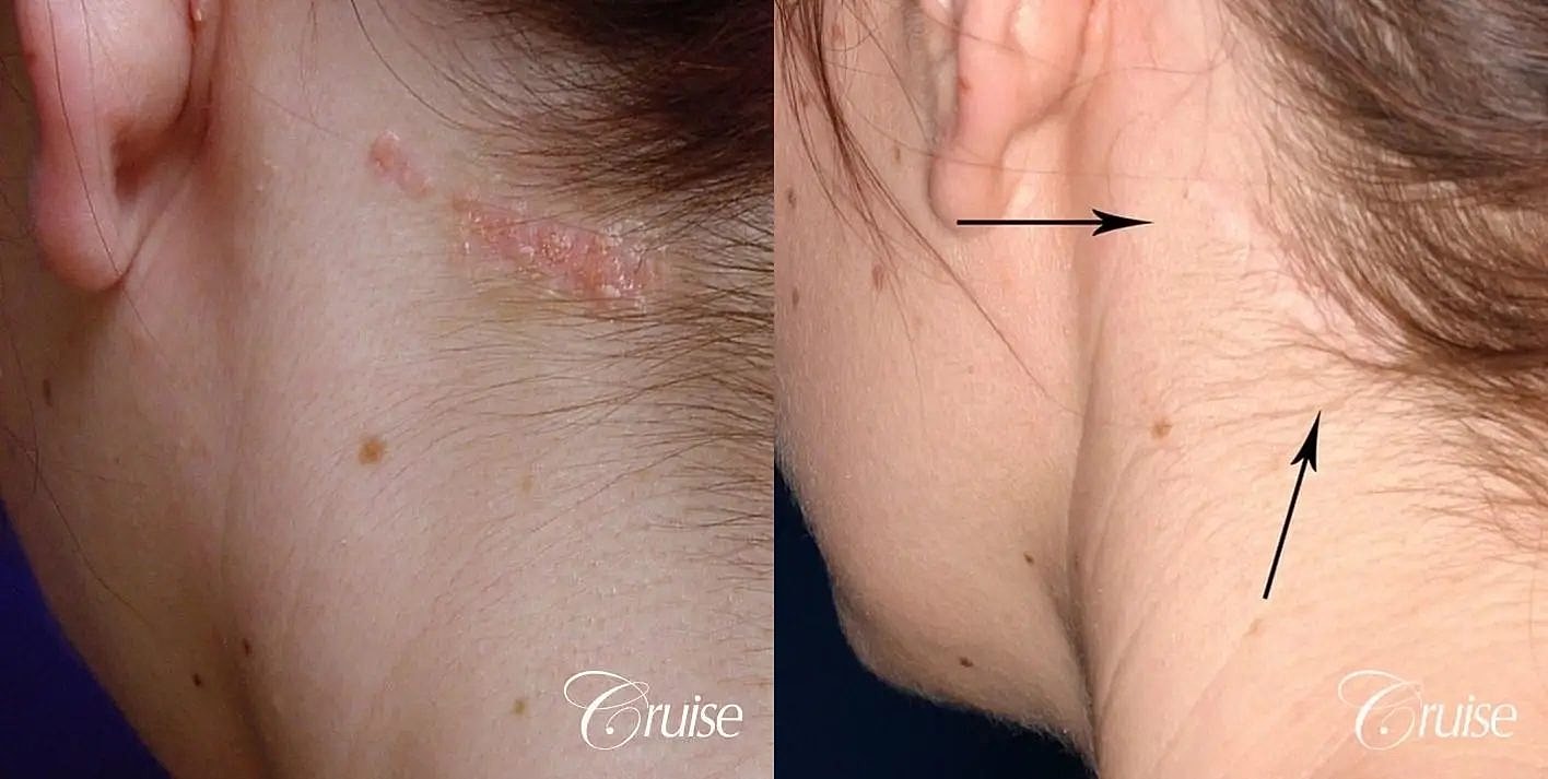 Scar Revision Before & After