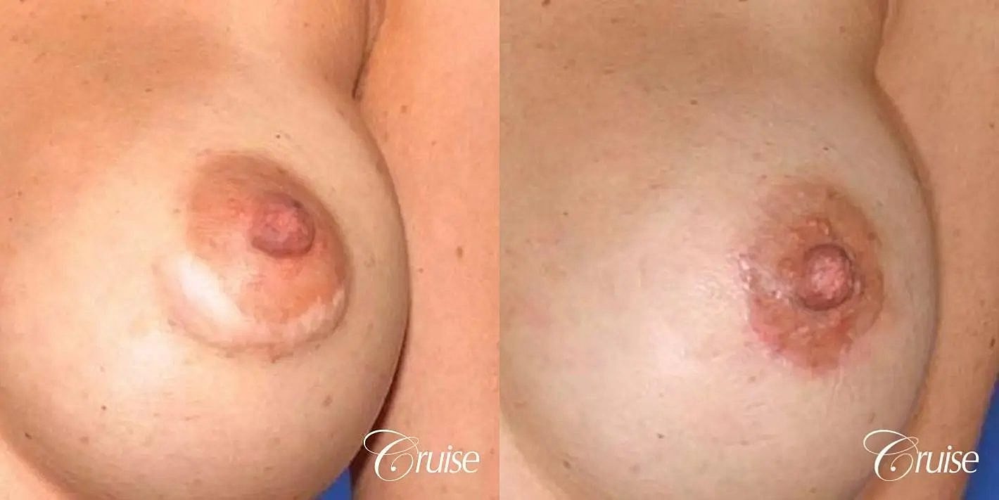 Scar Revision Before & After