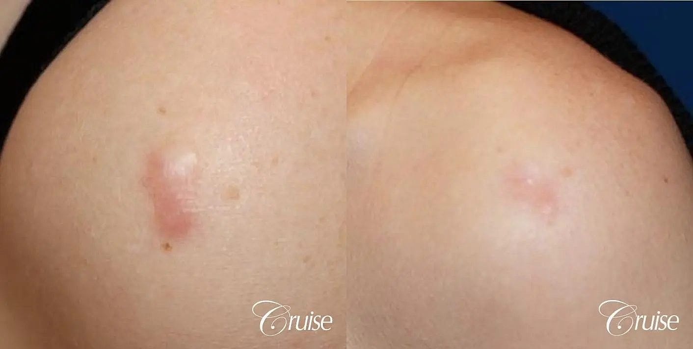 Scar Revision Before & After